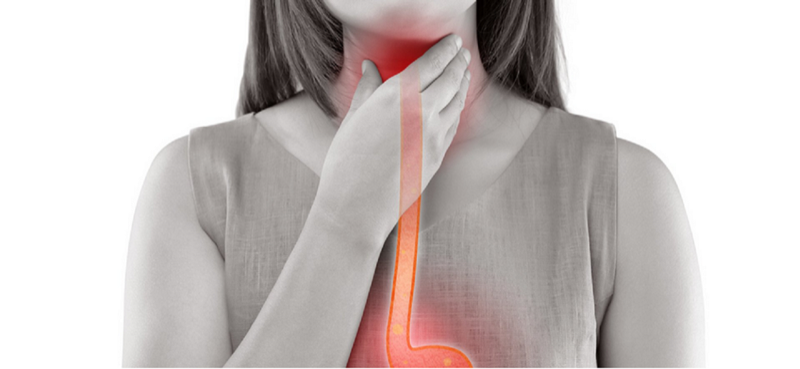 Medical illustration showing gastroesophageal reflux anatomy