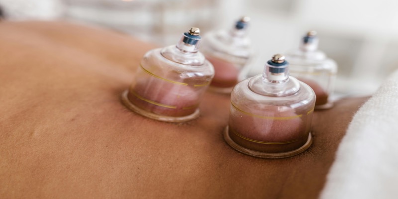Hijama cupping therapy session showing glass cups applied to patient's back