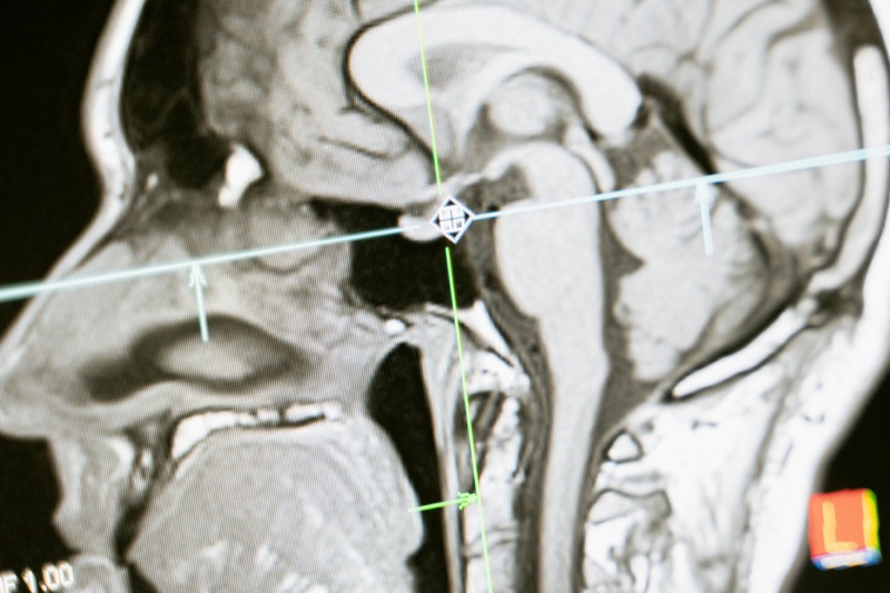 Medical X-ray scan showing neurological assessment for migraine diagnosis